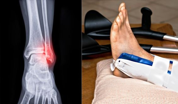 Rééducation après fracture de cheville — kinésithérapie à domicile au Maroc