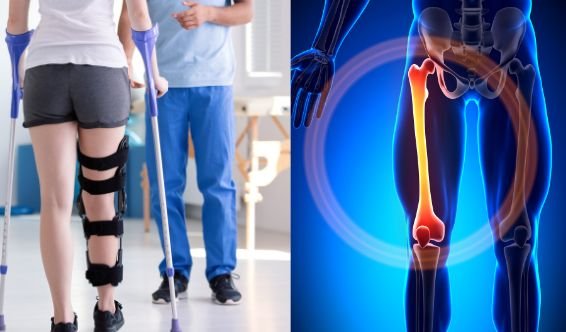 Rééducation après fracture du fémur — kinésithérapie à domicile au Maroc