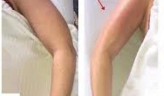 Drainage lymphatique genou avant après kiné à domicile Maroc