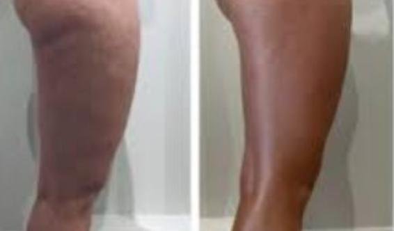 Drainage lymphatique jambe gonflée jambes lourdes kiné à domicile Maroc