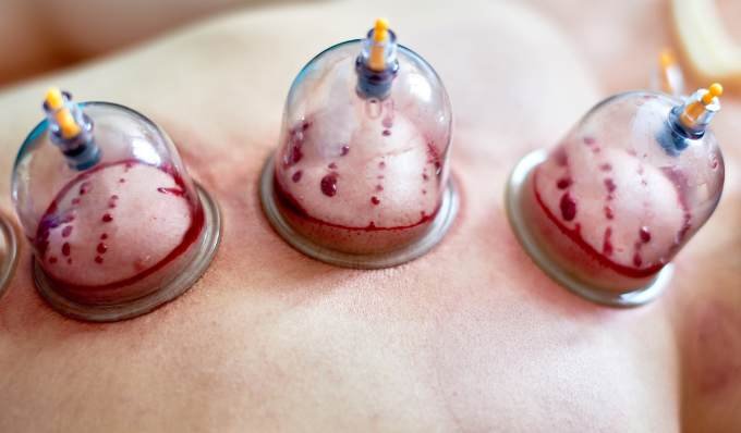 Hijama humide wet cupping saignée à domicile Maroc