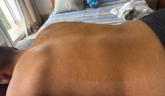 Séance acupuncture à domicile dos complet Maroc