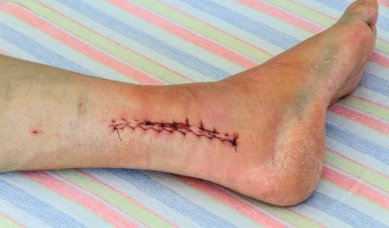 Rééducation après chirurgie de la cheville ou du tendon d’Achille — kinésithérapie à domicile au Maroc