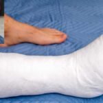 rééducation après fracture de la cheville